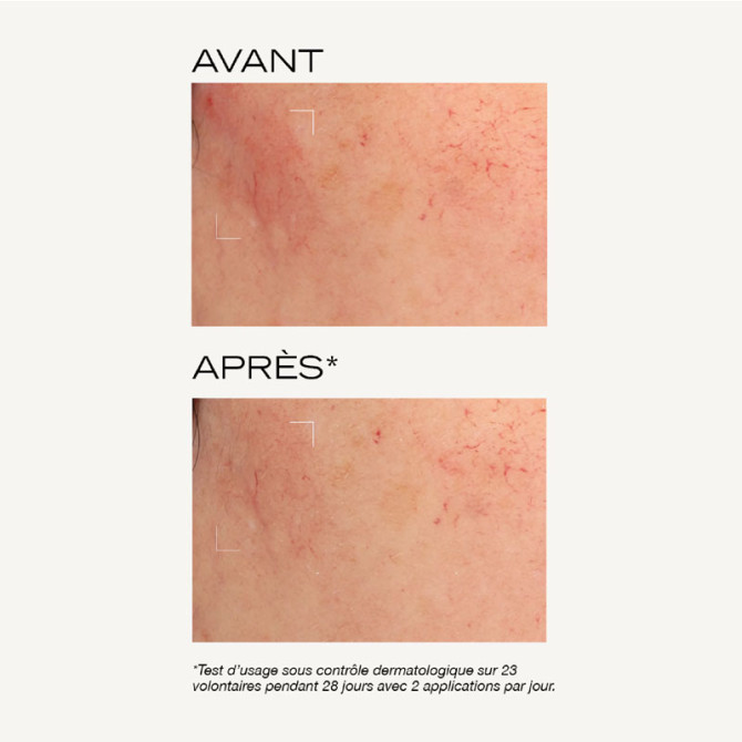 Intensiv-Peeling-Maske